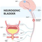 Neurogenic Bladder