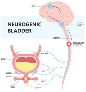 Neurogenic Bladder : Basics Neurogenic Bladder : Basics