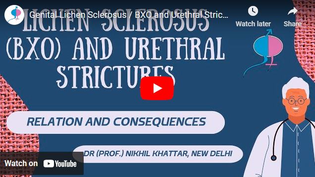 Genital Lichen Sclerosus / BXO and Urethral Stricture in Men