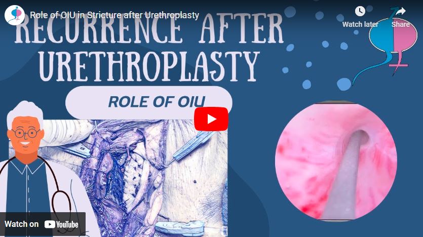 Role of OIU in Stricture after Urethroplasty