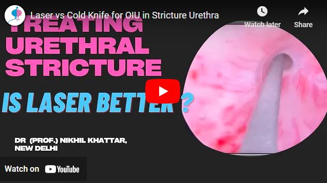 Laser vs Cold Knife for OIU in Stricture Urethra