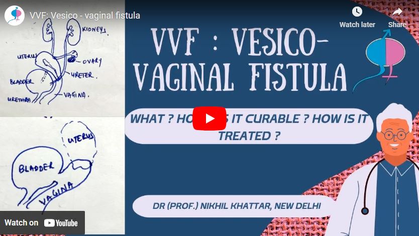 VVF: Vesico – vaginal fistula